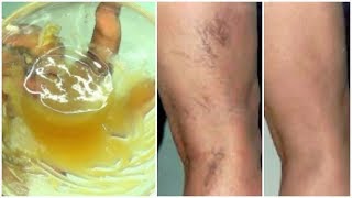 LOOK WHAT I USE ON MY VARICOSE VEINS  SPIDER VEINS GET RID OF VARICOSE VEINS FAST Khichi Beauty [upl. by Rashida]