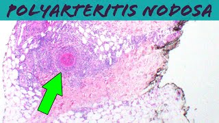 Polyarteritis Nodosa vasculitis pathology dermpath dermatology usmle dermatopathology [upl. by Gran]