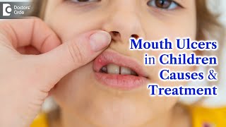 Mouth Ulcers in Children  MOUTH ULCER Treatment amp Causes  Dr K Saranya  Doctors Circle [upl. by Eet]