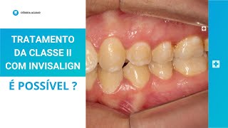 TRATAMENTO DA CLASSE II COM INVISALIGN Aprenda a planejar com attachments e elásticos de Classe II [upl. by Aleahcim840]