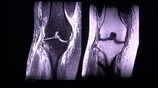 Anterior cruciate ligament tear in MR imaging by RadiologieTV [upl. by Nysila]