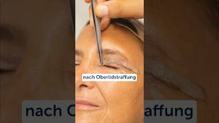 Oberlidstraffung LidKorrektur oberlid AntiAging Operation Ästhetik [upl. by Blessington16]