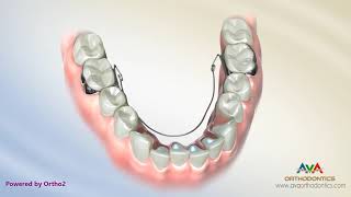 Orthodontic Expander or Spacer  Lower BiHelix Appliance [upl. by Dlonra260]