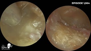 1564  Bilateral Rare Canal Cholesteotoma Patient Waiting 25 Years to be seen by ENT [upl. by Rosco]