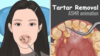 ASMR Tartar removal animation  Dental Scaling  Satisfying [upl. by Ardnazxela]