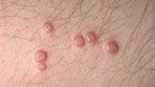 DermTV  Molluscum Contagiosum DermTVcom Epi 445 [upl. by Niltag]