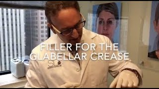 Filler For The Glabellar Crease [upl. by Rudy247]