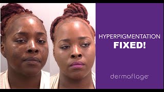 Hyperpigmentation Customer Testimonial a Concealer That Will Not Rub Off [upl. by Juline]