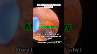 eartubesurgery eartubes adenoidectomy adenoidremoval adenoids eartubesurgery eartubes [upl. by Herrod]