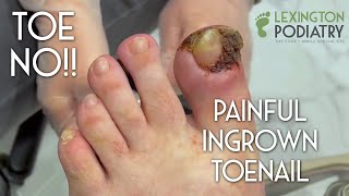 TOE NO Painful Ingrown Toenail Removal [upl. by Inger]