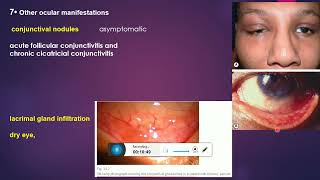 sarcoidosis and uveitis [upl. by Amandi]