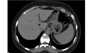 Hepatic Lipoma [upl. by Clotilda]