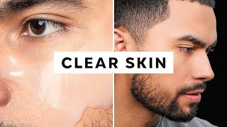 How To Get Clear Skin Only 3 Steps [upl. by Hollington]