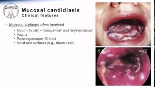 Candida Mucosal candidiasis [upl. by Yesdnil]