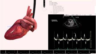 HeartWorks Multilobed Left Atrial Appendage [upl. by Ramad]