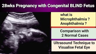 Congenital Blind Fetus  Ultrasound 28 wks Pregnancy [upl. by Eduam]