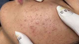 ACNE TREATMENT VU QUYNH MI Acne On Teens Cheek 2024 [upl. by Yelekalb215]