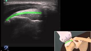 Démo 3D  échographie dune tendinite de la coiffe des rotateurs  Échographe SonoSite [upl. by Sonaj]