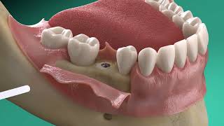 Straumann®️ GalvoSurge®️ Implant surface decontamination in periimplantitis treatment [upl. by Coughlin407]