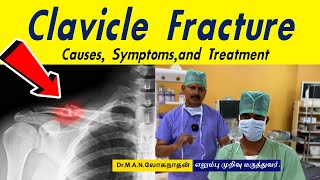 Clavicle Fracture surgery  Clavicle fracture treatment Tamil  Dr Loganathan [upl. by Dulcie]