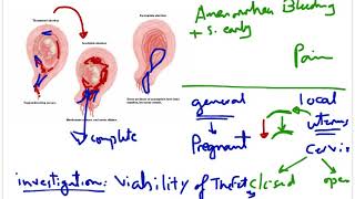 Abortion 2 quot Threatened abortion and its fates quot [upl. by Campos]