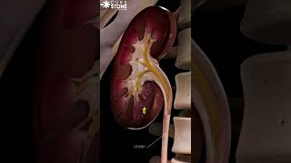 Treatment of kidney stones  How stones are removed  RIRS  Laser treatment shorts [upl. by Moshe]