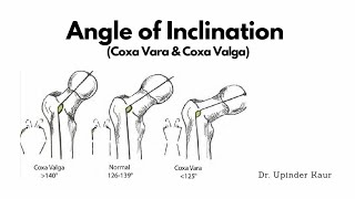 Angle of InclinationCoxa Valga and Coxa Vara [upl. by Leid]