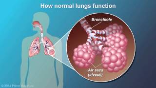 Understanding COPD [upl. by Volding]