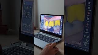 🦷💻✍🏻 exocad cadcam teeth dentistry dentist [upl. by Sanborn830]