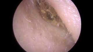 270  Ear Wax Removal from Entire Ear Canal using Microsuction [upl. by Prosser]