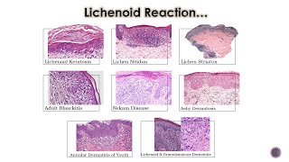 8 Lichenoid Dermatoses 2 [upl. by Tsew]