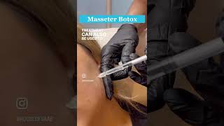 Masseter Botox Treatment jawline goalsmasseterbotox masseter [upl. by Nnailuj]