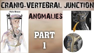 CRANIOVERTEBRAL JUNCTION ANOMALIES  PART1  SOFT TISSUE ANOMALIES  BONY ANOMALIES [upl. by Bald]