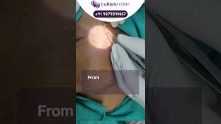 Mole Excision With Radiofrequency Cautery By Expert Surgeon At Best Clinic In Surat Gujarat [upl. by Nnaael]