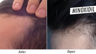 Minoxidil Antes e Depois tratamento contra calvicie [upl. by Caleb]