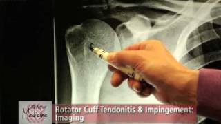 Rotator Cuff Impingement amp Tendonitis Part 2 Symptoms amp Evaluation [upl. by Dogs]