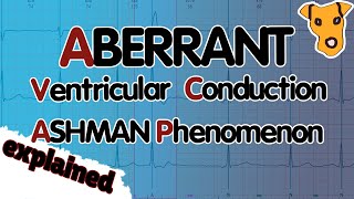 ABERRANT VENTRICULAR CONDUCTION Ashman Phenomenon Explained [upl. by Notsrik]