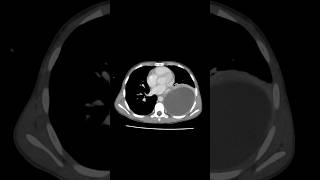 Pulmonary hydatid cyst ctchest [upl. by Sigrid189]