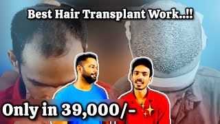 Hair Transplant Journey of Patient in Delhi  Low cost Hair Transplant [upl. by Devy]