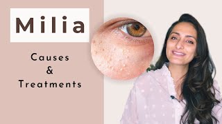 Milia  What is milia  Causes Treatment  dermatologist  Dr Aanchal Panth [upl. by Ailadi605]