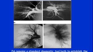 Chronic Thromboembolic Pulmonary Hypertension  Medical Therapy [upl. by Mikal]