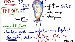 Preterm Premature Rupture Of Membrane On Ultrasound [upl. by Vanderhoek]