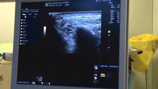 TRIGEMINAL NERVE BLOCK ultrasound guided [upl. by Ecahc]