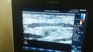 Duplex US of RT radial artery artery showing radial artery occlusion by thrombus [upl. by Ytomit]