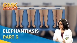 Elephantiasis Symptoms Causes and Treatment Part 3  Usapang Pangkalusugan [upl. by Nitsej]