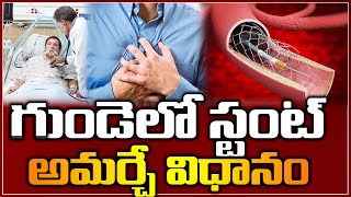 గుండెలో స్టంట్ అమర్చే విధానం  How Stent is Implanted Inside the Heart  Health Tips  Arogya Mantra [upl. by Fricke]