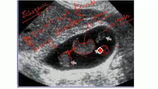 Diagnosis of Tumefactive sludge within gallbladder [upl. by Adnor]