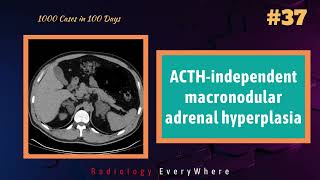 ACTHindependent macronodular adrenal hyperplasia  1000 videos in 100days  video 37 [upl. by Ylek917]