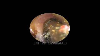 CERUMENV3 Impacted ear wax removed Endoscopic suction clearance [upl. by Bogusz]