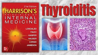 THYROIDITIS  Classification  Causes  Clinical Features  Treatment  Harrision [upl. by Hal]